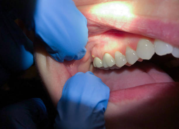 Best Emergency Tooth Extraction in Eudora, KS