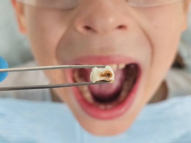 Best Emergency Tooth Extraction in Eudora, KS
